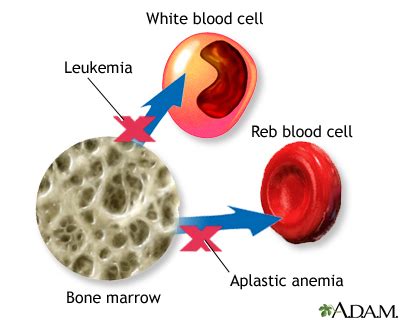 Anemia: MedlinePlus Medical Encyclopedia